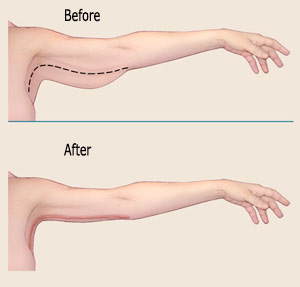 armlift-procedure