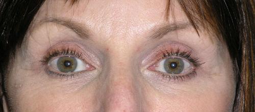 Blepharoplasty Before & After Patient #713