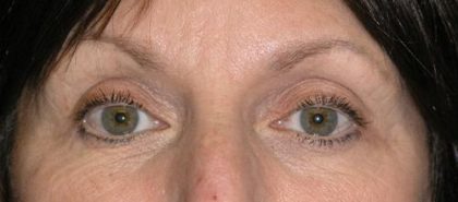 Blepharoplasty Before & After Patient #713