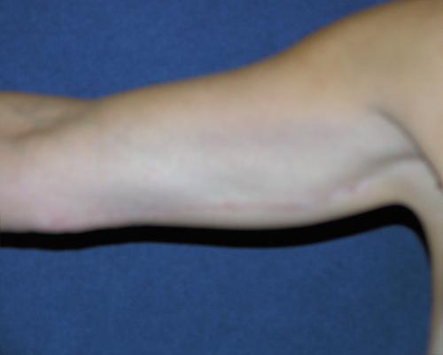Arm Lift Before & After Patient #579