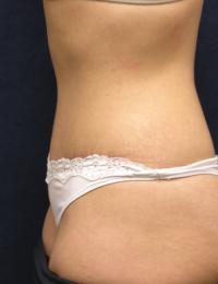 Tummy Tuck Before & After Patient #605