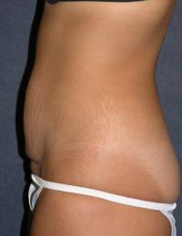 Tummy Tuck Before & After Patient #605