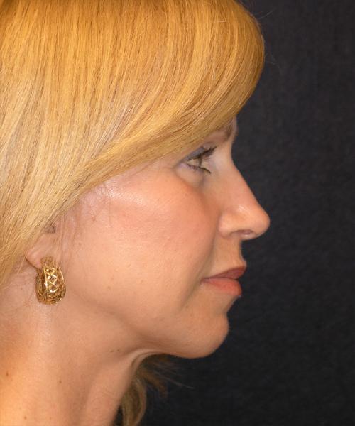 Mid Facelift Before & After Patient #729