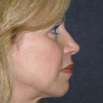 Mid Facelift Before & After Patient #729