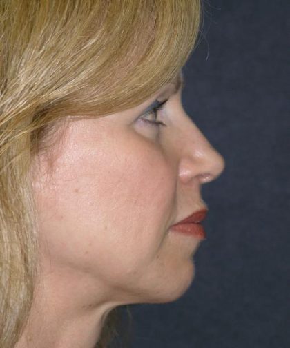Mid Facelift Before & After Patient #729