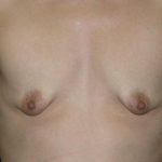 Breast Augmentation Before & After Patient #676