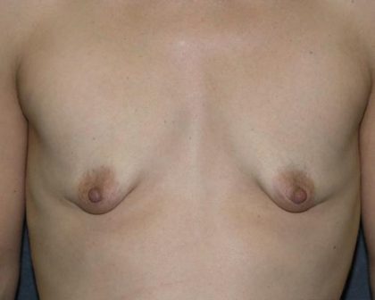 Breast Augmentation Before & After Patient #676