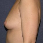 Breast Augmentation Before & After Patient #671