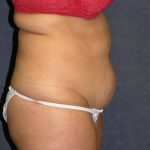 Tummy Tuck Before & After Patient #600