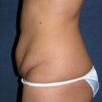 Tummy Tuck Before & After Patient #595