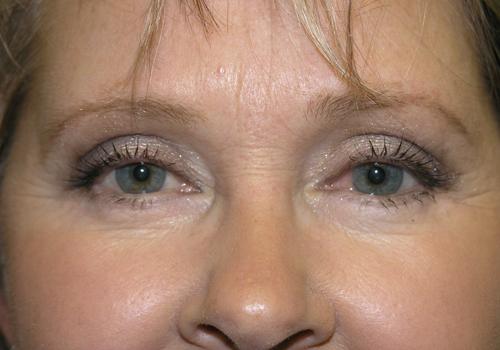 Blepharoplasty Before & After Patient #710