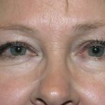 Blepharoplasty Before & After Patient #710