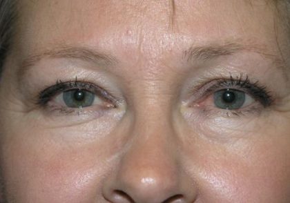 Blepharoplasty Before & After Patient #710