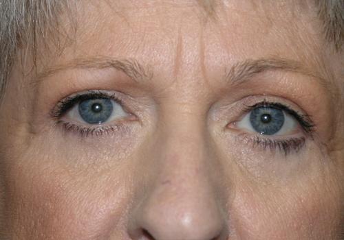 Blepharoplasty Before & After Patient #707