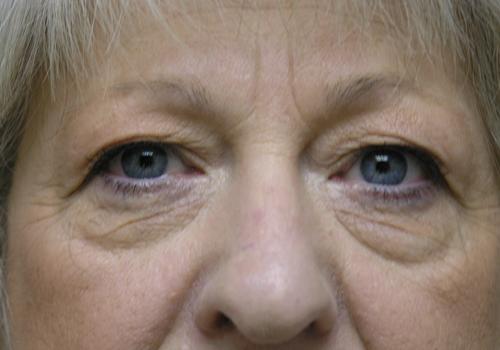 Blepharoplasty Before & After Patient #707