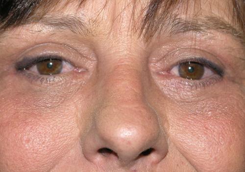 Blepharoplasty Before & After Patient #704