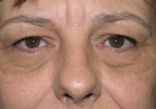 Blepharoplasty Before & After Patient #704