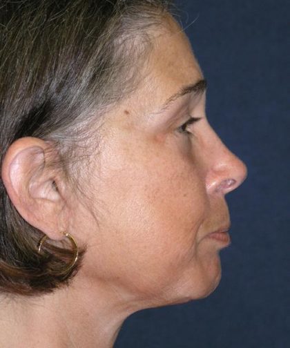 Facelift Before & After Patient #721