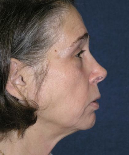 Facelift Before & After Patient #721