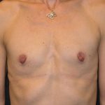 Breast Augmentation Before & After Patient #661