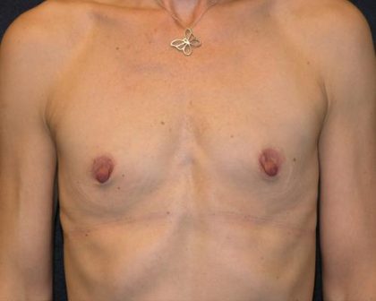 Breast Augmentation Before & After Patient #661