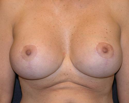 Breast Augmentation Before & After Patient #651