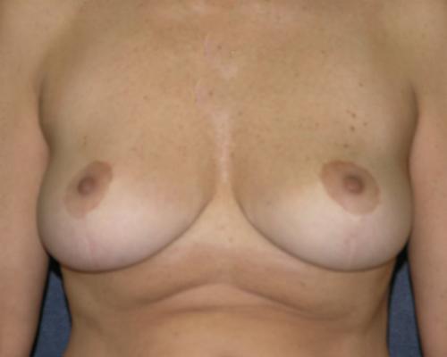 Breast Augmentation Before & After Patient #651