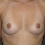 Breast Augmentation Before & After Patient #646