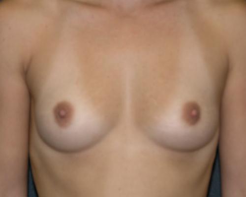 Breast Augmentation Before & After Patient #646