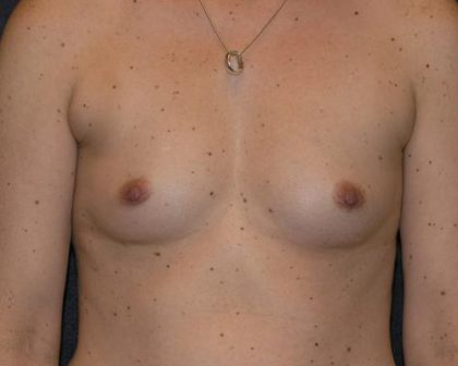 Breast Augmentation Before & After Patient #640