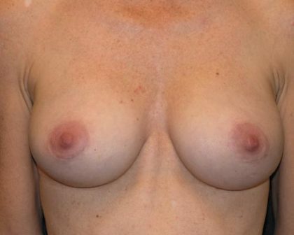 Breast Augmentation Before & After Patient #635