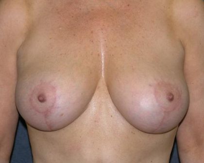 Breast Lift Before & After Patient #681