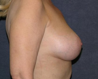 Breast Lift Before & After Patient #681
