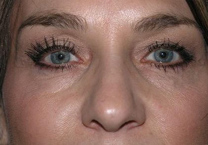 Blepharoplasty Before & After Patient #698