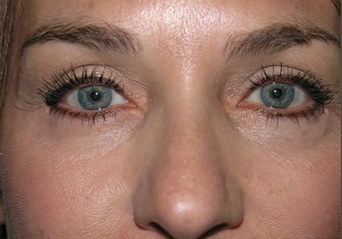 Blepharoplasty Before & After Patient #698