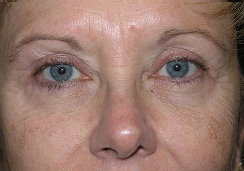 Blepharoplasty Before & After Patient #693