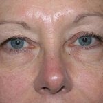 Blepharoplasty Before & After Patient #693
