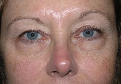 Blepharoplasty Before & After Patient #693
