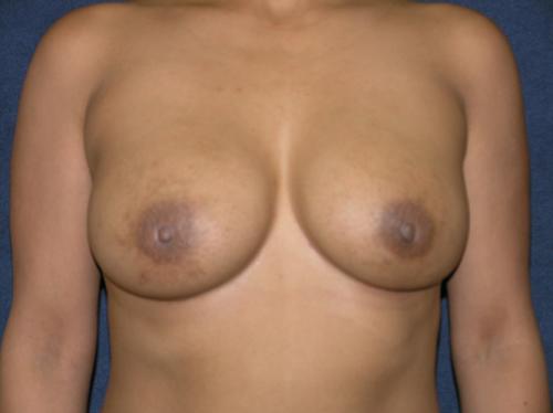 Breast Augmentation Before & After Patient #617