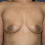 Breast Augmentation Before & After Patient #617