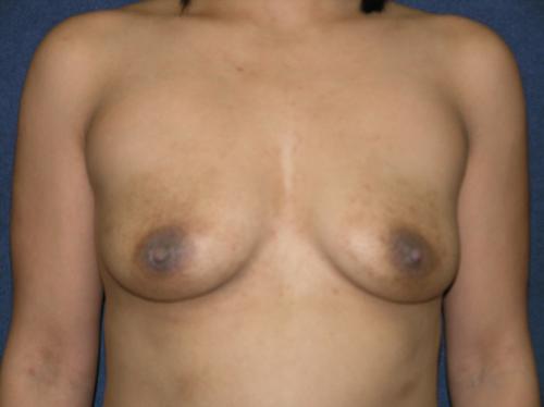 Breast Augmentation Before & After Patient #617