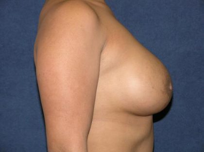 Breast Augmentation Before & After Patient #617