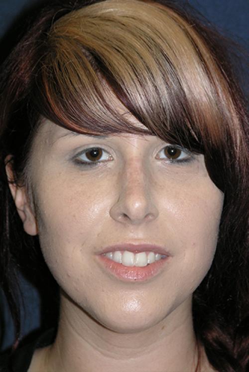 Rhinoplasty Before & After Patient #732