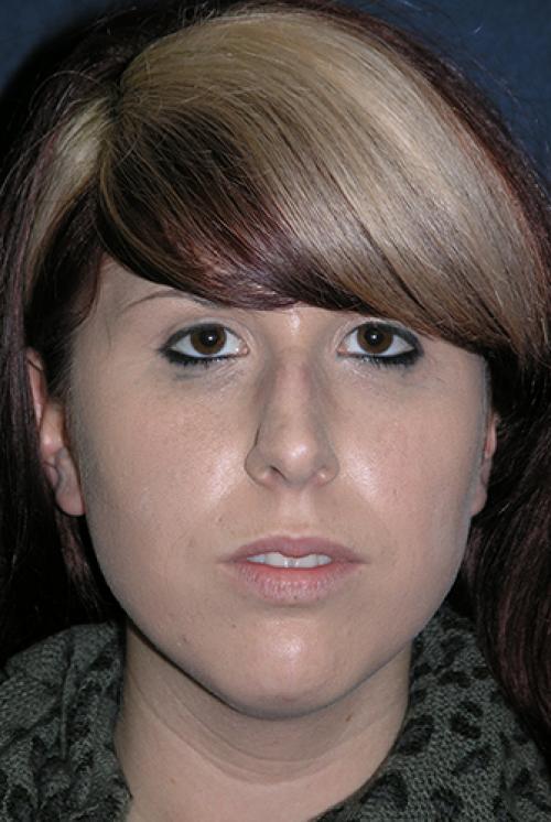 Rhinoplasty Before & After Patient #732