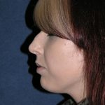 Rhinoplasty Before & After Patient #732