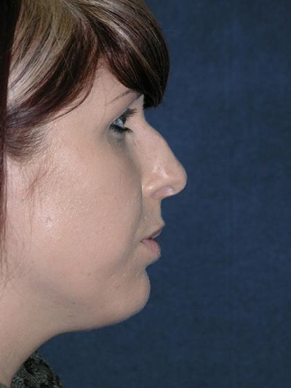 Rhinoplasty Before & After Patient #732