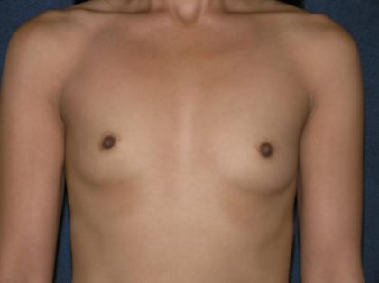 Breast Augmentation Before & After Patient #610