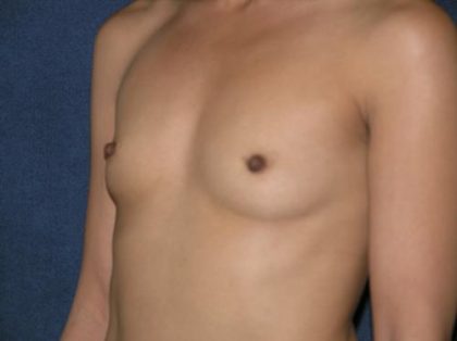 Breast Augmentation Before & After Patient #610