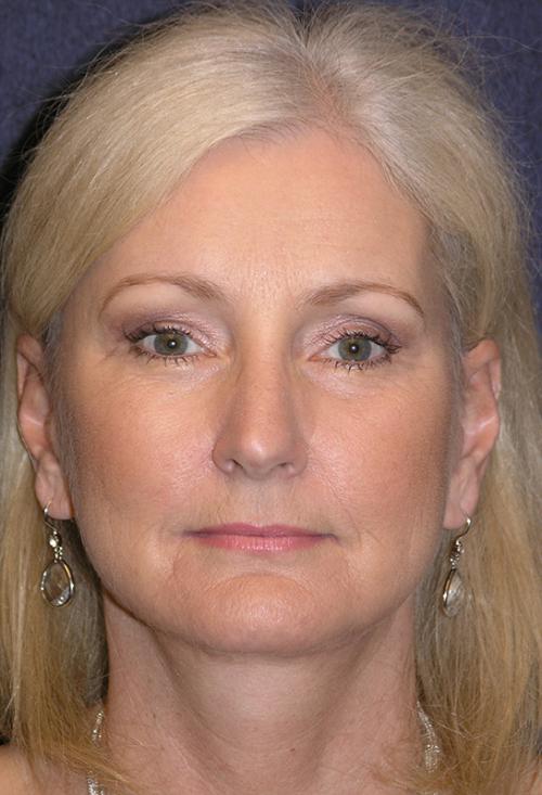 Facelift Before & After Patient #716