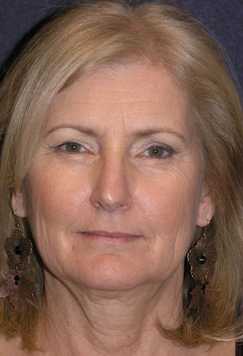 Facelift Before & After Patient #716